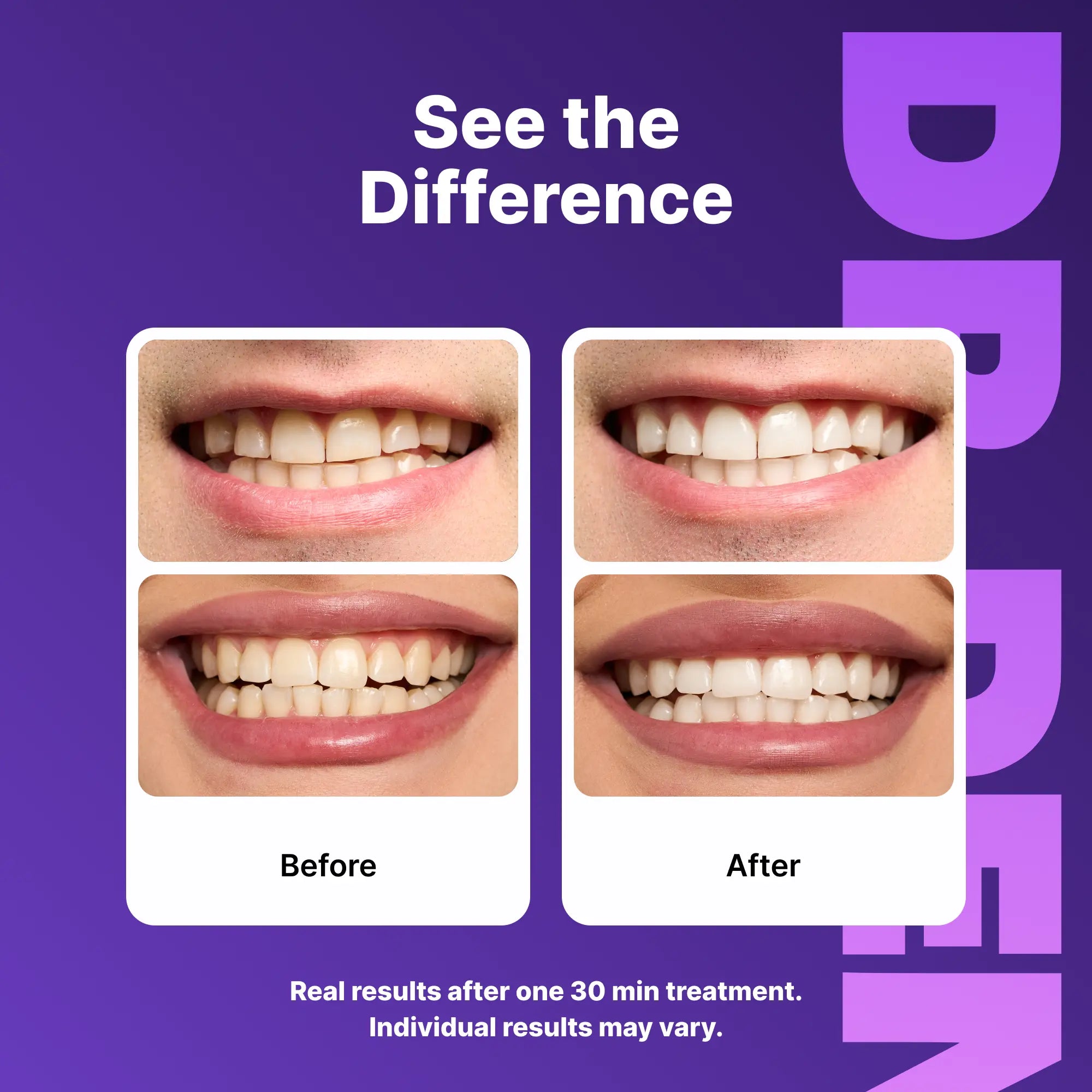 Achieve a Dazzling Smile with DRDENT Purple Teeth Whitening Strips - 7/21 Sessions of Non-Sensitive, Peroxide-Free Whitening